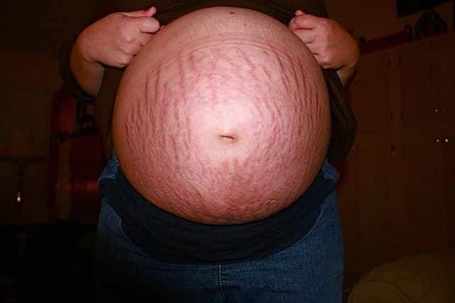 eliminar las estrias en el embarazo
